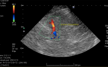 Aterosclerose Intracraniana