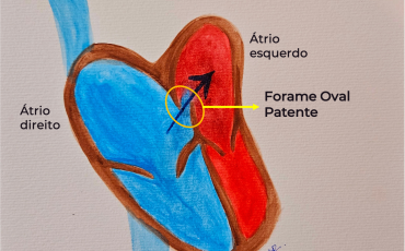 Forame Oval Patente e AVC